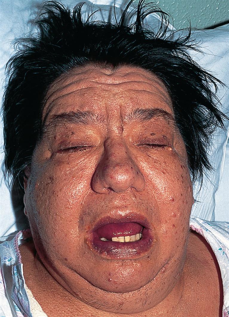 A closeup of a person’s bloated face with ruffled hair, closed eyes, and open mouth.
