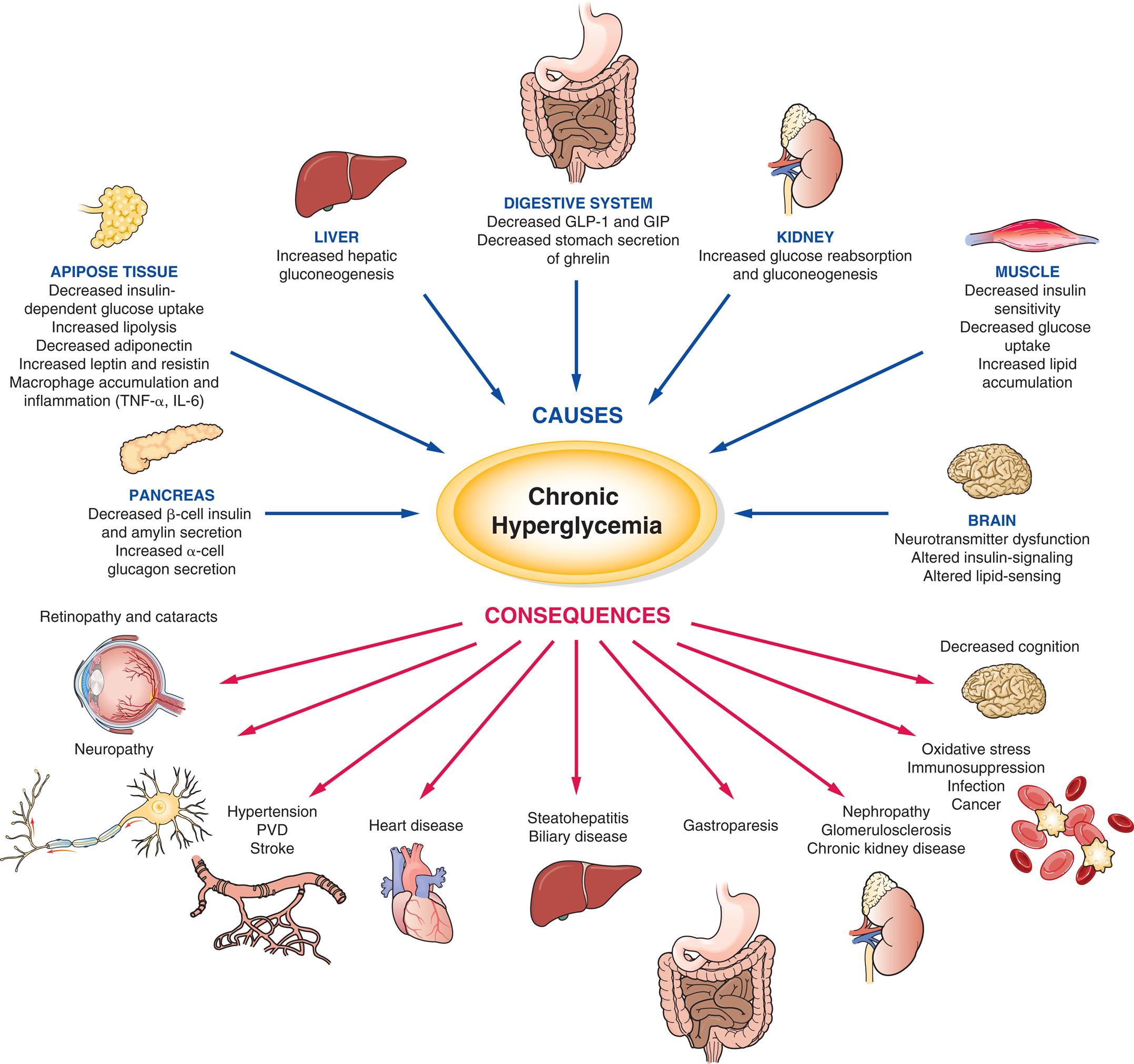 An illustration lists the causes and consequences of chronic hyperglycemia. The causes of chronic hyperglycemia are as follows. • Pancreas. Decreased beta-cell insulin and amylin secretion. Increased alpha-cell glucagon secretion. • Adipose tissue. Decreased insulin-dependent glucose uptake. Increased lipolysis. Decreased adiponectin. Increased leptin and resistin. Macrophage accumulation and inflammation (T N F-alpha, I L-6). • Liver. Increased hepatic gluconeogenesis. • Digestive system. Decreased G L P-1 and G I P. Decreased stomach secretion of ghrelin. • Kidney. Increased glucose reabsorption and gluconeogenesis. • Muscle. Decreased insulin sensitivity. Decreased glucose uptake. Increased lipid accumulation. • Brain. Neurotransmitter dysfunction. Altered insulin-signaling. Altered lipid-sensing. The consequences of chronic hyperglycemia are as follows. • Decreased cognition. • Oxidative stress. Immunosuppression. Infection. Cancer. • Nephropathy. Glomerulosclerosis. Chronic kidney disease. • Gastroparesis. • Steatohepatitis. Biliary disease. • Heart disease. • Hypertension. P V D. Stroke. • Neuropathy. • Retinopathy and cataracts.