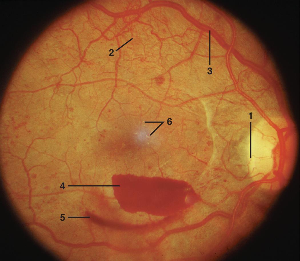 A closeup of optic nerves with diabetic retinopathy.