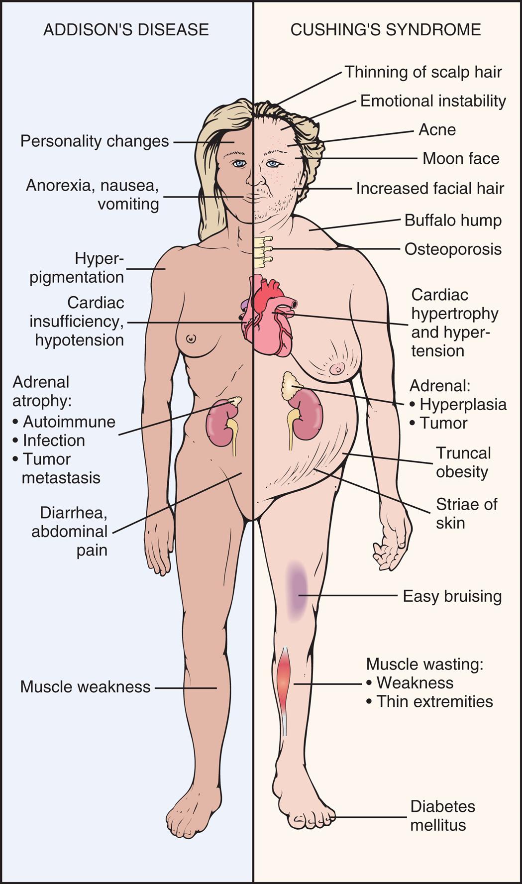 An illustration of the anterior view of a person identifies and labels the symptoms for Addison’s disease and Cushing’s syndrome. The symptoms of Addison’s disease are as follows. • Personality changes. • Anorexia, nausea, vomiting. • Hyperpigmentation. • Cardiac insufficiency, hypotension. • Adrenal atrophy: autoimmune, infection, and tumor metastasis. • Diarrhea, abdominal pain. • Muscle weakness. The symptoms of Cushing’s syndrome are as follows. • Thinning of scalp hair. • Emotional instability. • Acne. • Moon face. • Increased facial hair. • Buffalo hump. • Osteoporosis. • Cardiac hypertrophy and hypertension. • Adrenal: hyperplasia and tumor. • Truncal obesity. • Striae of skin. • Easy bruising. • Muscle wasting: weakness and thin extremities. • Diabetes mellitus.