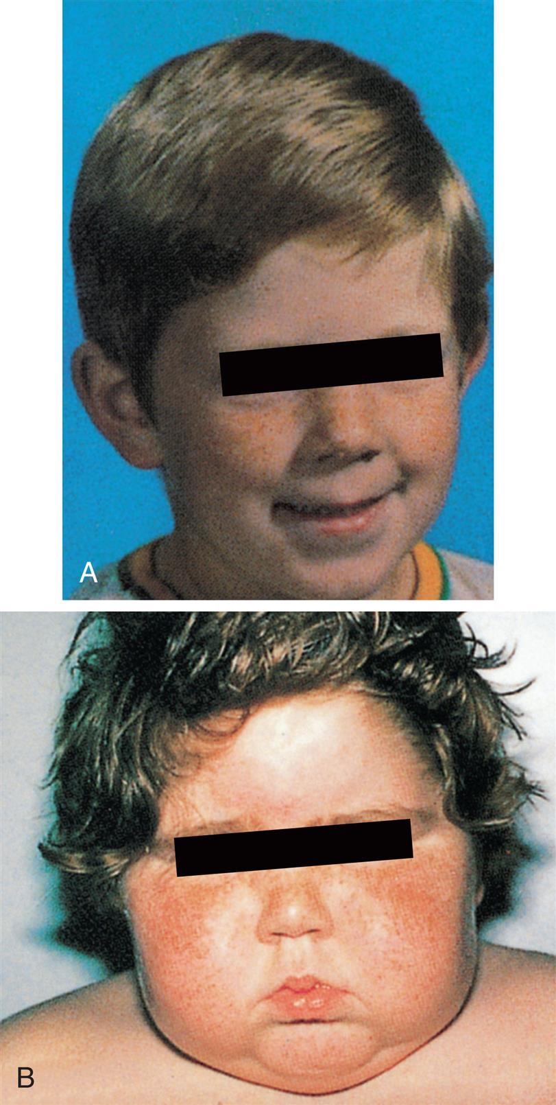 Closeup A shows a young boys’ face with the eyes blacked out. The boy appears normal. Closeup B shows a toddler’s bloated face with the eyes blacked out. The child’s face is puffy.