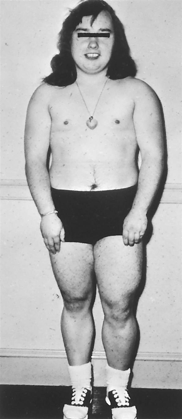 A black-and-white photo shows the anterior view of a girl in her underwear. She has masculine features, including a flat chest.
