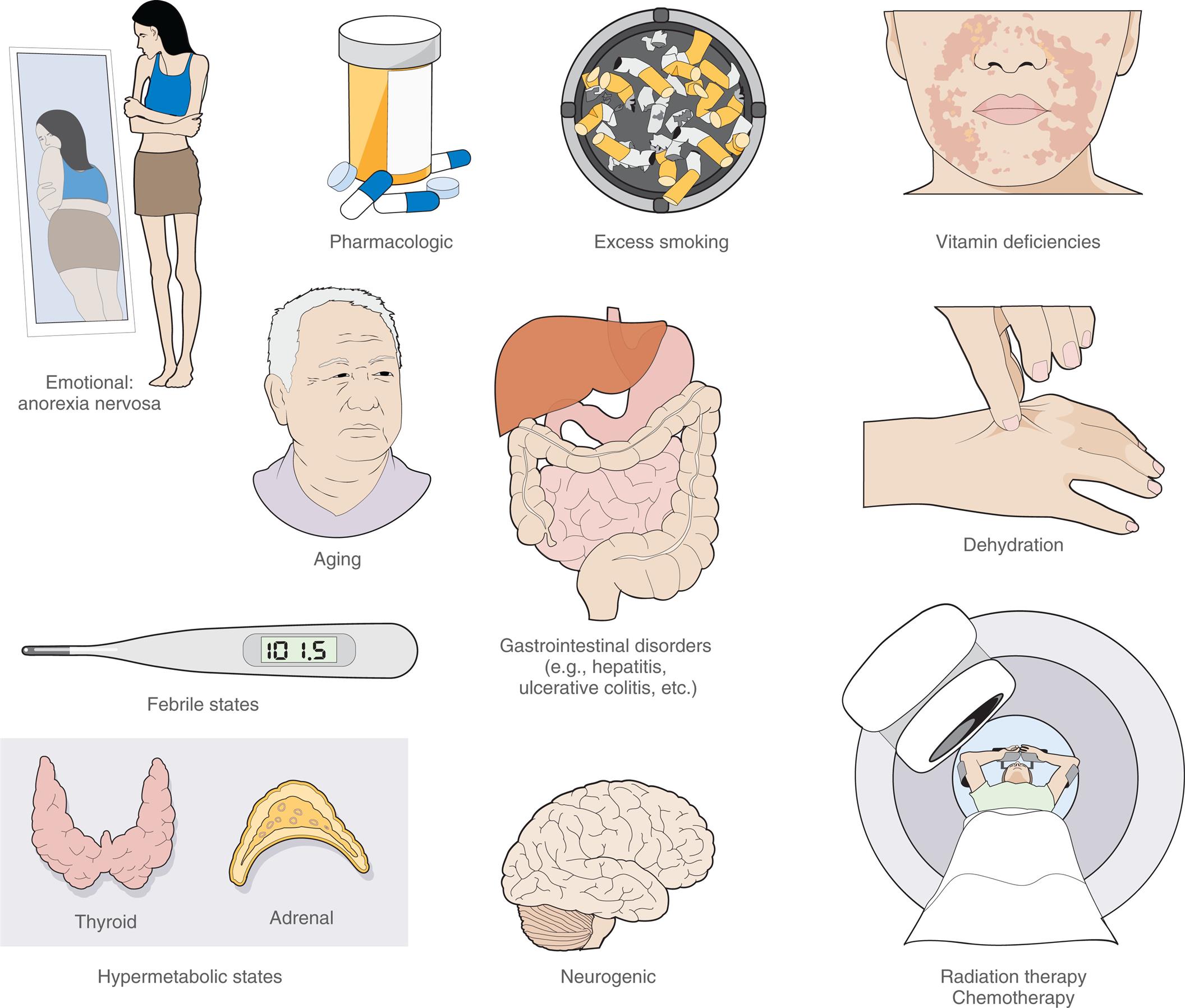 “A series of illustration shows the causes of anorexia. • Emotional: anorexia nervosa. The illustration shows a thin woman looking at a fat reflection of herself in the mirror. • Pharmacologic. The illustration shows a bottle of pills. • Excess smoking. The illustration shows a lot of cigarette buts in an ash tray. • Vitamin deficiencies. The illustration shows rashes on the jaws of a person. • Aging. The illustration shows the bust of an elderly person. • Febrile states. The illustration shows a thermometer registering a temperature of 101.5. • Gastrointestinal disorders (example, hepatitis, ulcerative colitis, et cetera) The illustration shows the digestive system. • Dehydration. The illustration shows a hand pinching the back of another hand. • Hypermetabolic states. The illustration shows the thyroid and the adrenal glands. • Neurogenic. The illustration shows a lateral view of the brain. • Radiation therapy, chemotherapy. The illustration shows a person underdoing a radiation treatment.”