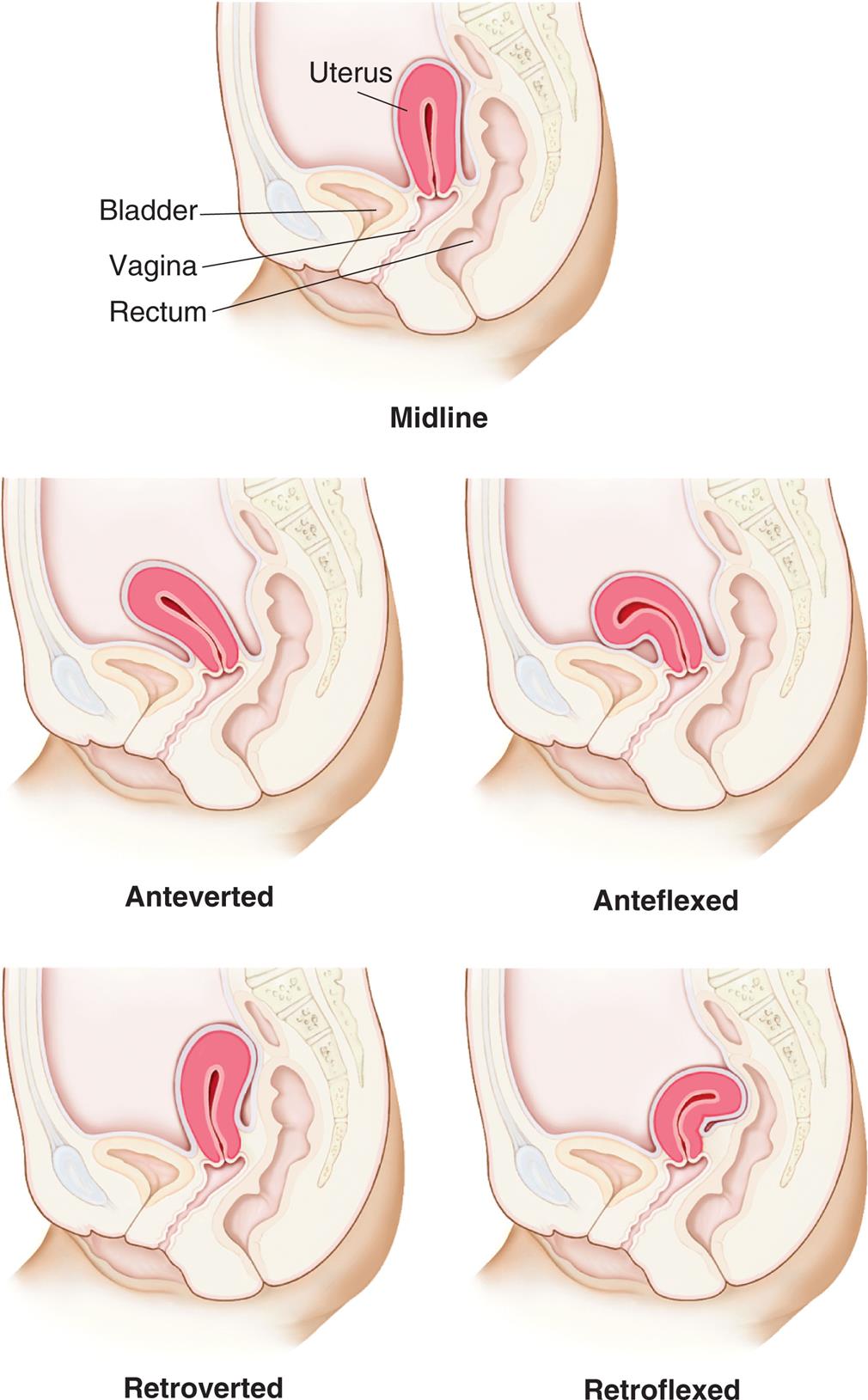 “An illustration of the lateral view of the pelvis, showing the uterus, bladder, vagina, and rectum, highlights the variations in uterine positions. Top panel, midline. The uterus is vertical. Middle-left panel, anteverted. The uterus is bent toward to the bladder. Middle-right panel, anteflexed. The uterus is curled toward the bladder. Bottom-left panel, retroverted. The uterus is bent away from the bladder. Bottom-right panel, retroflexed. The uterus is pressing at the rectal wall.”