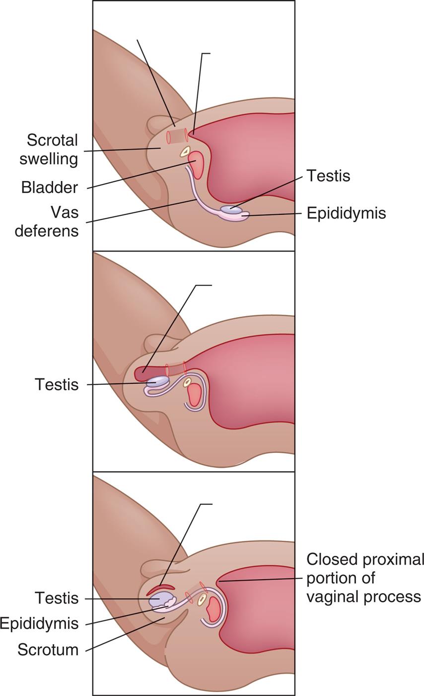 “Three illustrations demonstrate the descent of a testis. Top panel. The illustration shows the scrotal swelling, the bladder, vas deferens, testis, and epididymis. The testis and the epididymis are away from the scrotal swelling and bladder. Middle panel. The testis has descended from the back and into the scrotal swelling. Top panel. The illustration shows the testis and the epididymis in the scrotum. The closed proximal portion of vaginal process is highlighted.”