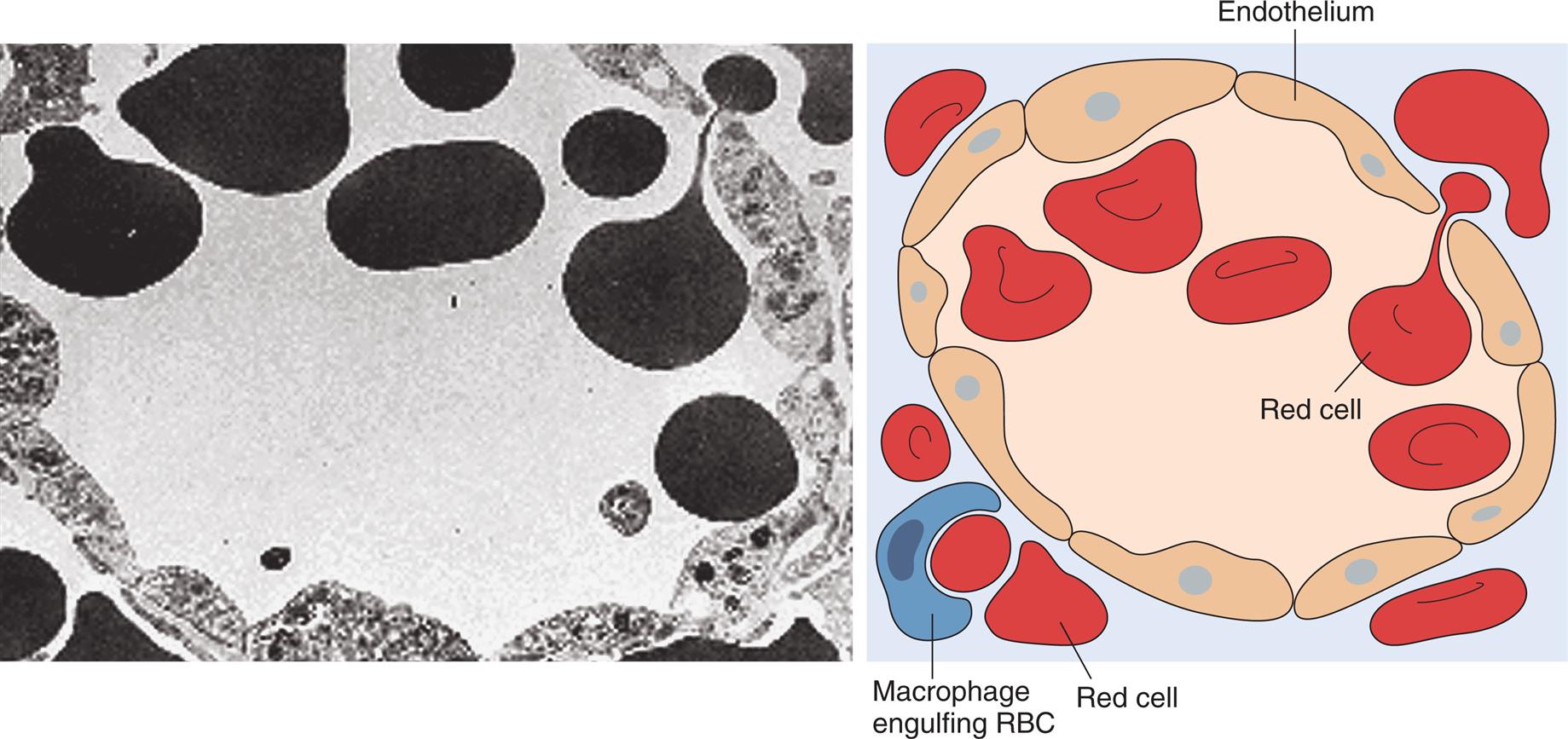 A photomicrograph shows a ring of endothelium cells, surrounded by red cells. An accompanying illustration shows a similar ring of endothelium cells, surrounded by red cells. A macrophage engulfing R B C is also identified in the illustration.