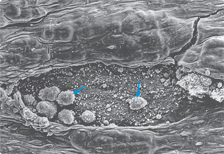 A photomicrograph identified leukocytes on the subendothelium.