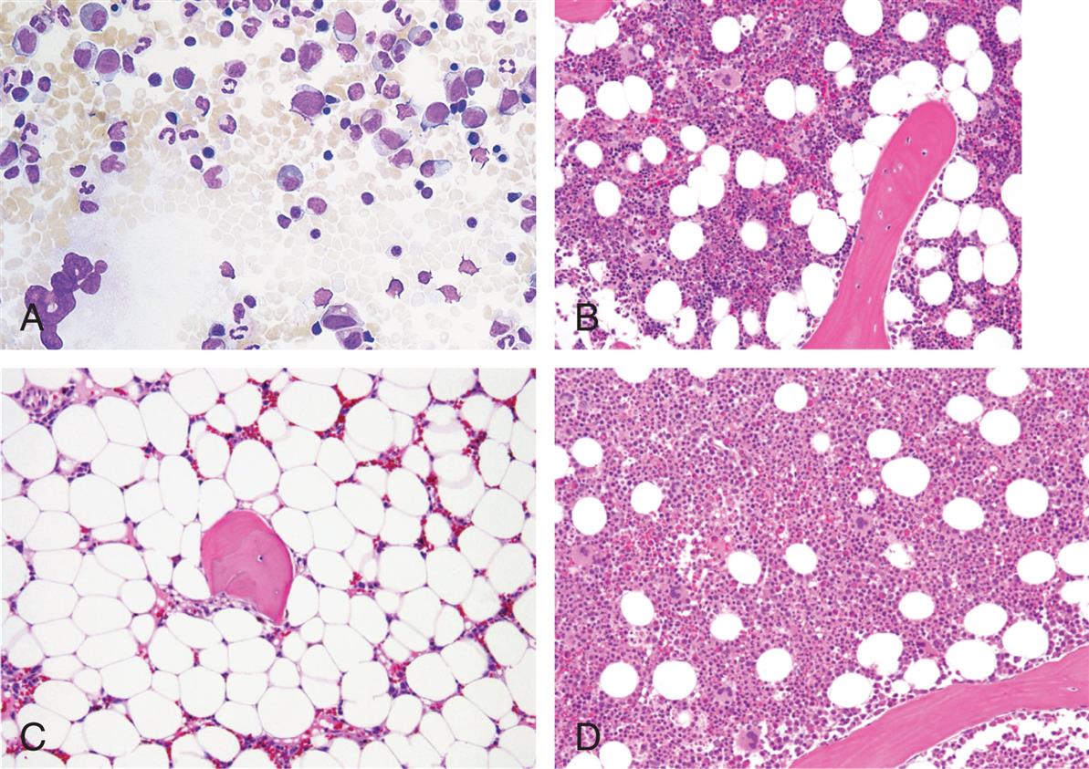 Four photomicrographs, A, B, C, and D, show bone marrow samples. A. Normal bone marrow. There is a normal amount of hematopoietic cells. B. Hypocellularity. There is a decreased amount of hematopoietic cells. C. Aplastic Anemia or hypercellularity. There is an increased amount of large hematopoietic cells. D. Malignant. There are very less hematopoietic cells.