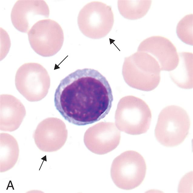 Three photomicrographs show variations in erythrocyte sizes. Top panel, A. The cell comprises hemoglobin and a layer of membrane. Middle panel, B. The cell comprises hemoglobin and a hardly visible layer of membrane. Bottom panel, C. The cell comprises hemoglobin with no membrane.