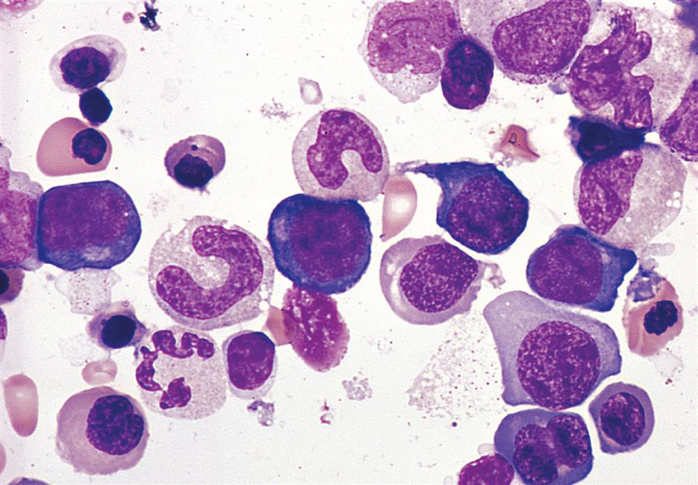 A photomicrograph of bone marrow shows dispersed chromatin in the nuclei of the red blood cells.