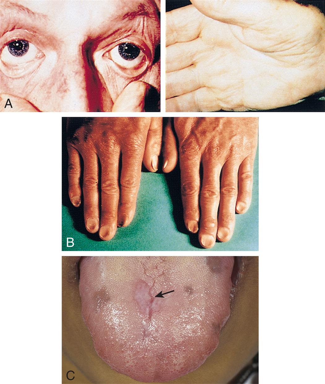 Four closeups show manifestations of iron deficiency anemia. Top panel, A. The closeup on the left shows creased eyes. The closeup on the right shows creased palms. Middle panel, B. The closeup shows the nails with concave dents at the center and elevated edges. Bottom panel, C. The closeup shows fissures on a person’s tongue.