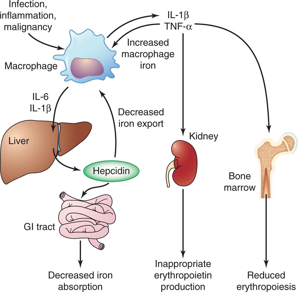 An illustrated flowchart shows the mechanism for the anemia of inflammation. • T N F-alpha triggers the bone marrow in producing reduced erythropoiesis. • T N F-alpha triggers the kidney in producing inappropriate erythropoietin. • T N F-alpha produces increased macrophage iron. • Infection, inflammation, and malignancy macrophage produces I L-1 beta. • I L-6 and I L-1 beta from macrophage triggers the liver in producing hepcidin. • Hepcidin decreases iron export to the macrophage. • Hepcidin triggers the G I tract in decreasing iron absorption.
