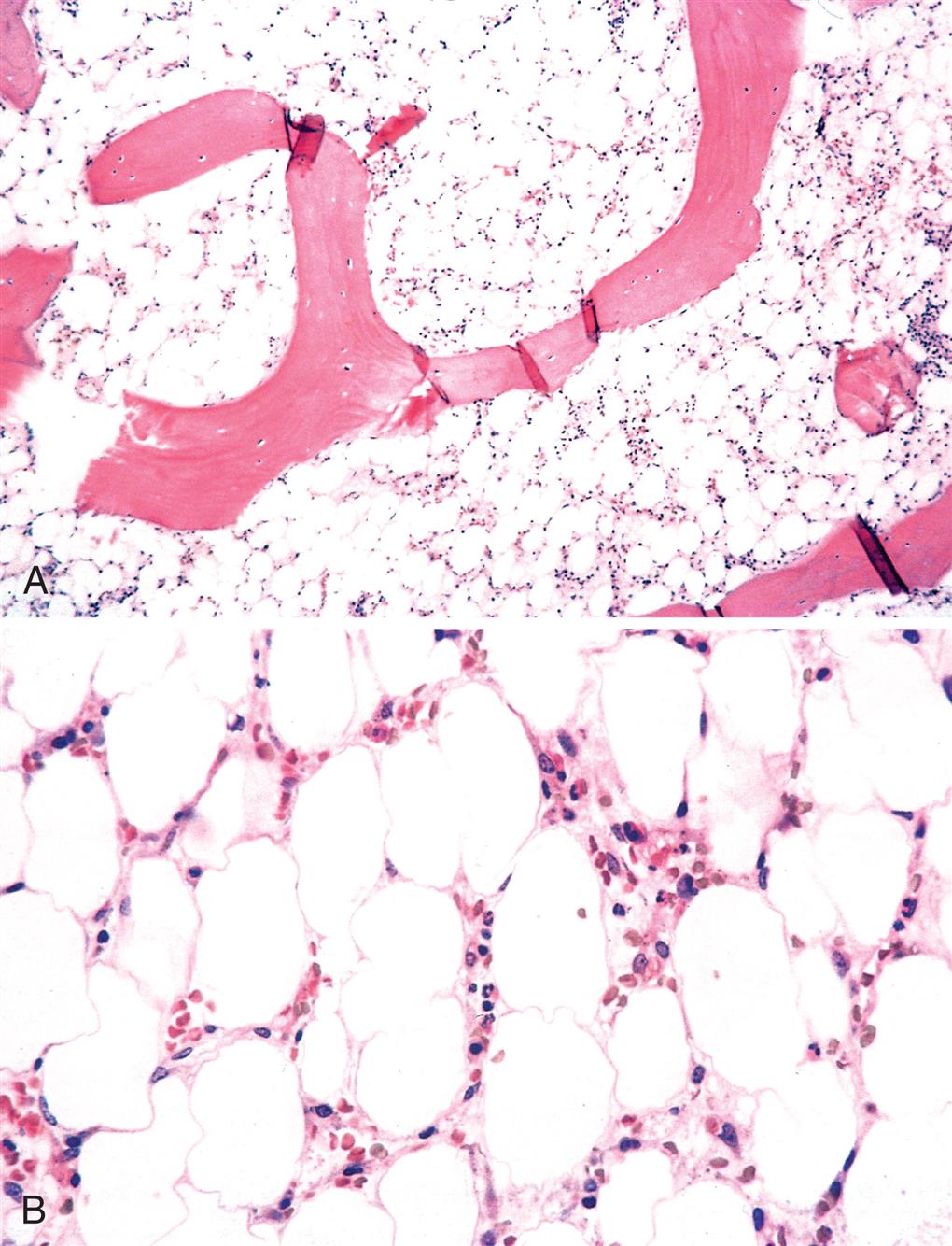 Two photomicrographs of aplastic anemia. Top panel, A. The photomicrograph, for low power, shows small macrophages. Bottom panel, B. The photomicrograph, for high power, shows large macrophages.