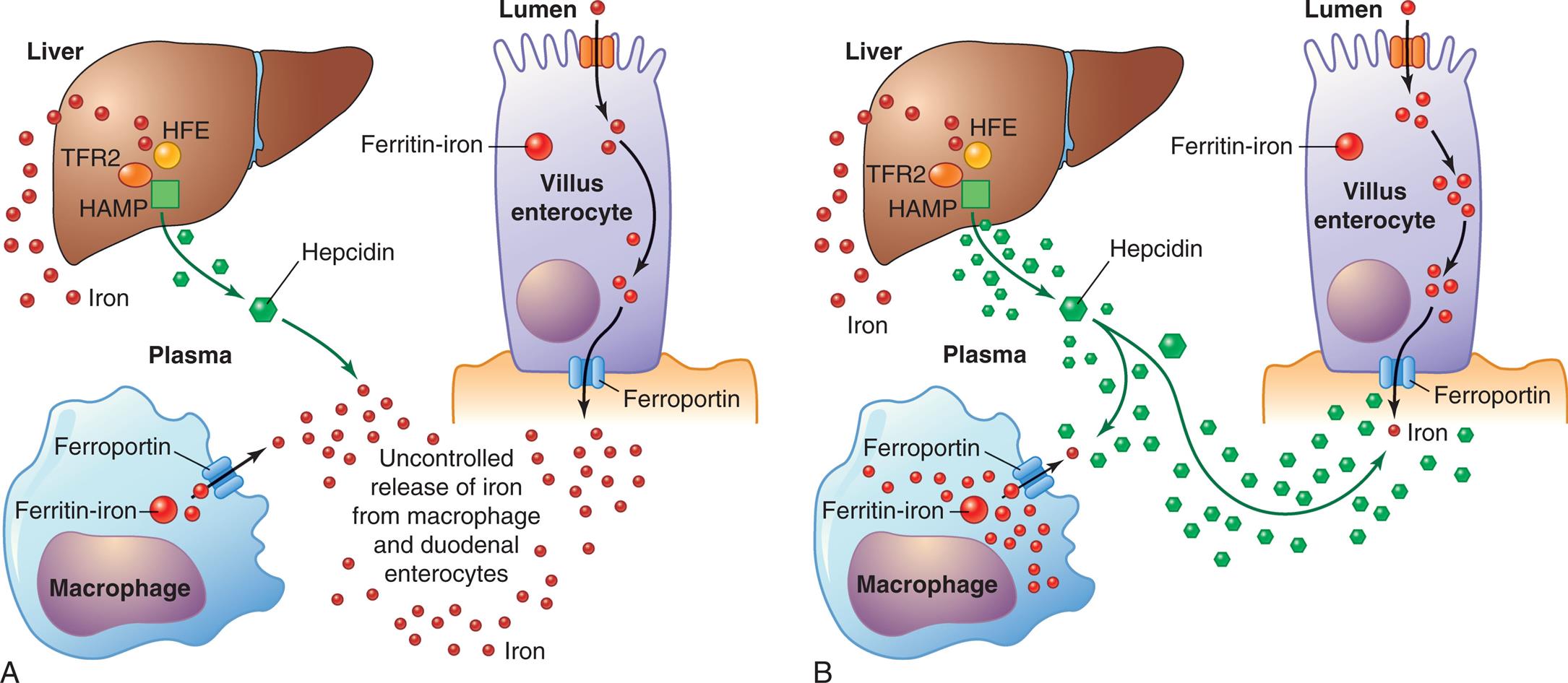 Left panel, A. The illustration shows a macrophage, the liver, and a lumen. The lumen and macrophage release iron not through the ferroportin. Mutations affecting T F R 2, H F E, and H A M P in the liver decrease hepcidin levels. Liver also releases iron. All factors lead to uncontrolled release of iron from macrophage and duodenal enterocytes. Right panel, B. The illustration shows macrophage, the liver, and a lumen. Mutations in the ferroportin of the macrophage and lumen result in the storage of iron within the cells. Normal hepcidin levels regulate the absorption of iron by the liver.