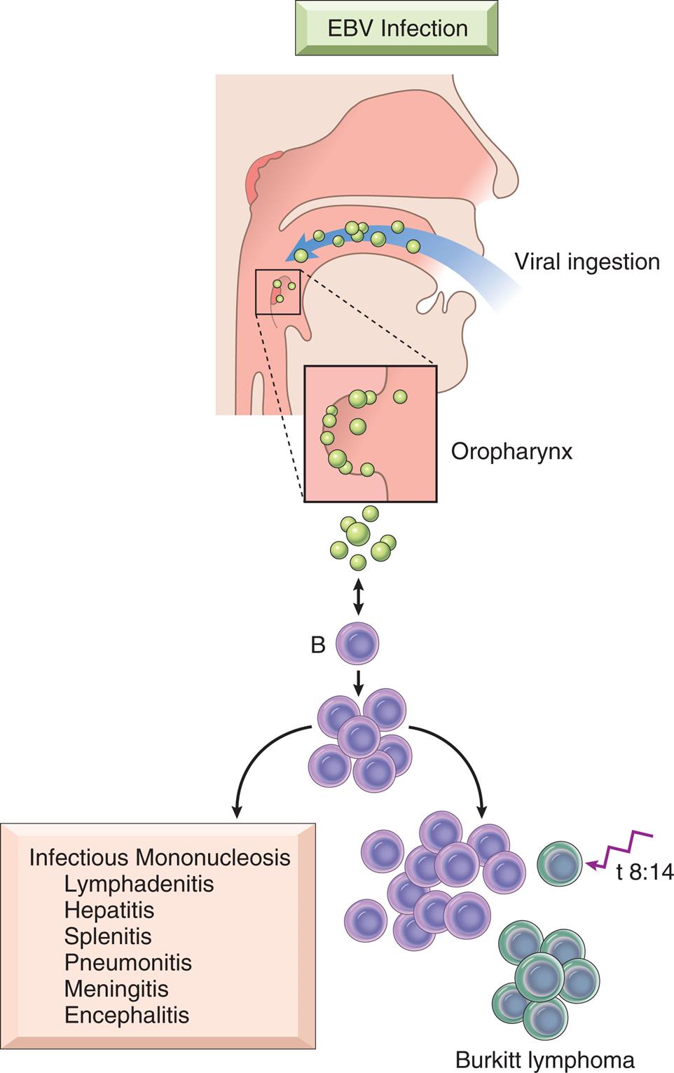An illustration shows the viral ingestion of E B V (through the mouth) and its passage through the oropharynx, resulting in the formation of B-cell and subsequent proliferation to Burkitt lymphoma. Outcomes of infectious mononucleosis include lymphadenitis, hepatitis, splenitis, pneumonitis, meningitis, and encephalitis.