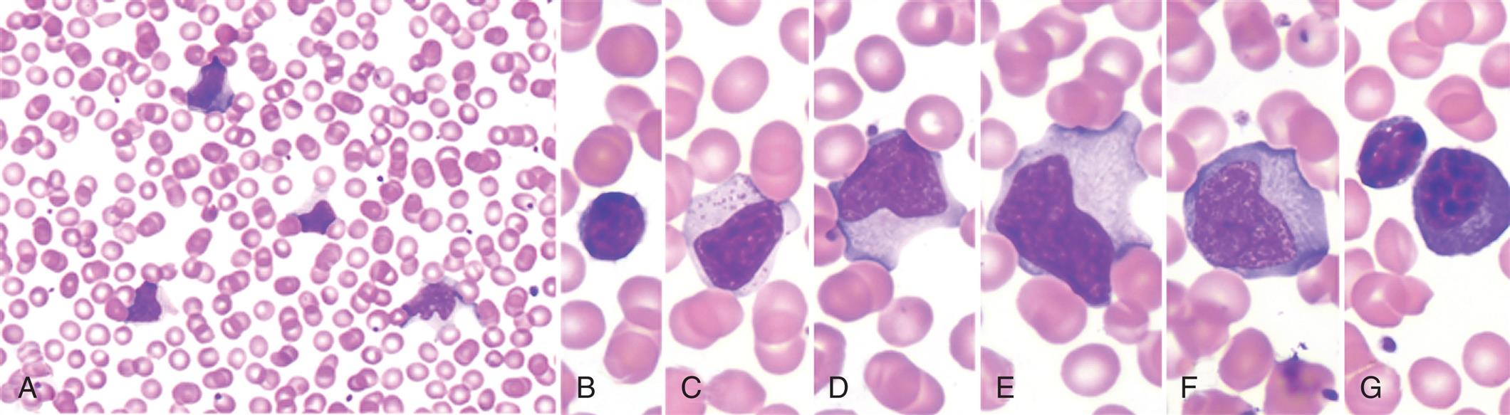 Seven photomicrographs of blood smears A through G show a high fraction of activated lymphocytes in the blood.