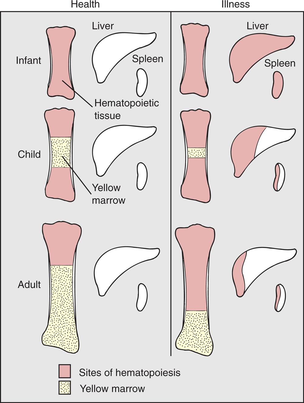 A series of illustration sets compare the sites of hematopoiesis in infant, child, and adult. Each illustration set shows a long bone, the liver, and the spleen. • Healthy infant: The entire bone comprises hematopoietic tissue. The liver and spleen are normal. • Sick infant: The bone, liver, and spleen comprise hematopoietic tissue. • Healthy child: The upper and lower segments of the bone comprise hematopoietic tissue. The central part of the bone comprises yellow marrow. The liver and spleen are normal. • Sick child: The yellow marrow in the bone is narrow, compared to that in the healthy child. Half the liver and half the spleen comprise hematopoietic tissue. • Healthy adult: Three-fourths of the bone comprises hematopoietic tissue. The liver and spleen are normal. • Sick adult: One-fourths of the bone comprises hematopoietic tissue. A very small segment of the liver and about half the spleen comprises hematopoietic tissue.