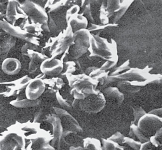 A photomicrograph shows a cluster of red blood cells and sickle red blood cells together.