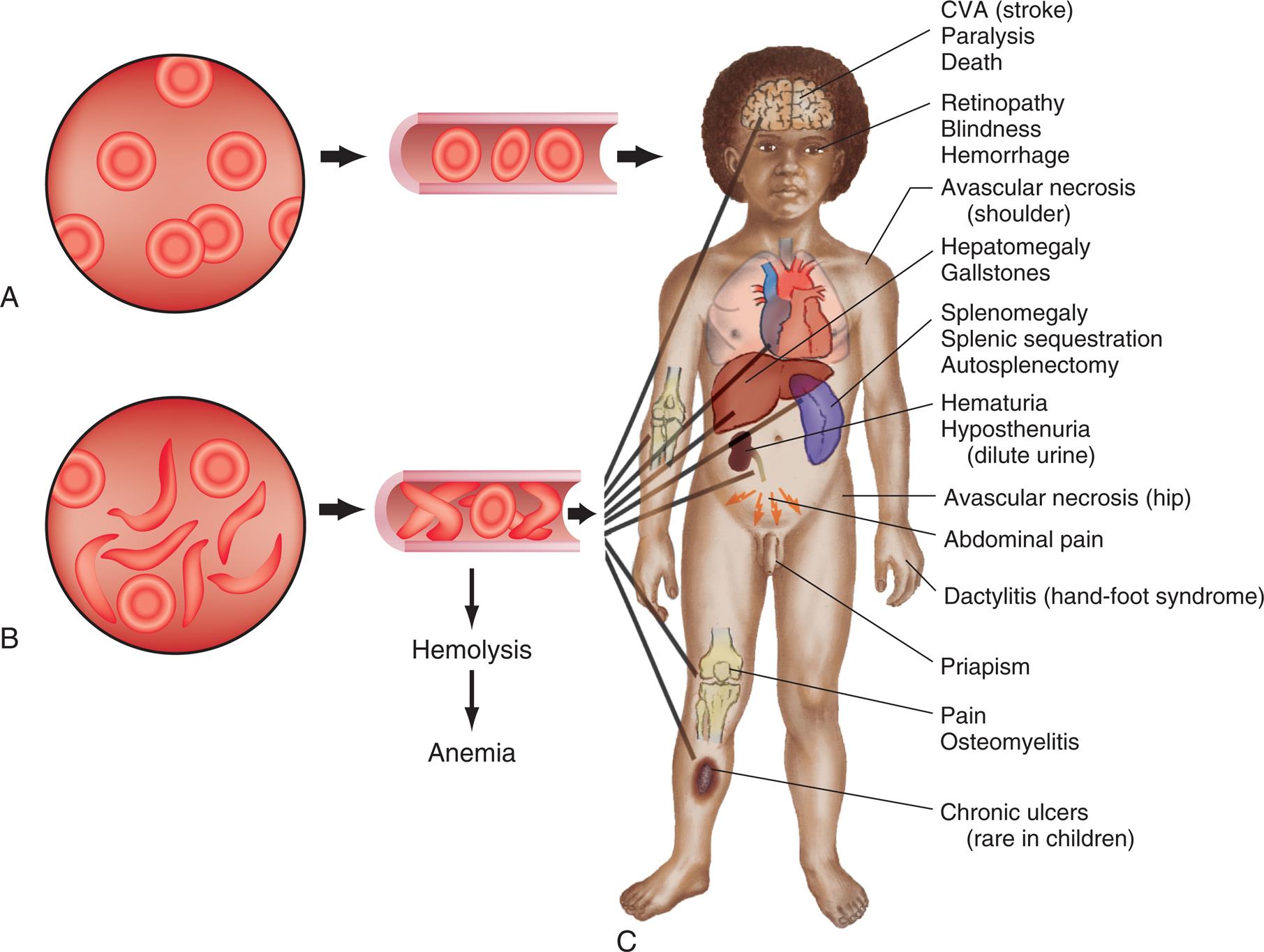 Top-left panel, A. The illustration shows normal red blood cells. Top-right panel, B. The illustration shows sickle and normal red blood cells. Right panel, C. An illustration of the anterior view of the human body identifies the following tissue effects from the top to the bottom. • C V A (stroke), paralysis, and death. • Retinopathy, blindness, and hemorrhage. • Avascular necrosis (shoulder). • Hepatomegaly and gallstones. • Splenomegaly, splenic sequestration, and autosplenectomy. • Hematuria and hyposthenuria (dilute urine). • Avascular necrosis (hip). • Abdominal pain. • Dactylitis (hand-foot syndrome). • Priapism. • Pain and osteomyelitis. • Chronic ulcers (rare in children).