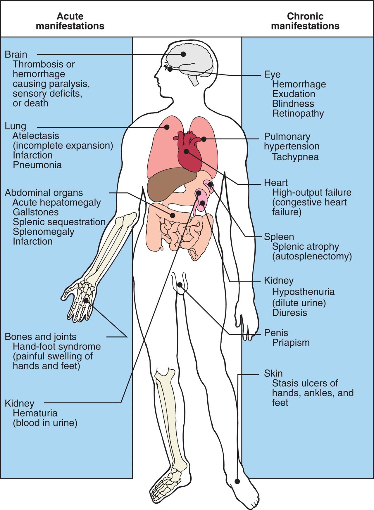 An illustration of the anterior view of the human body shows acute and chronic manifestations by organ. Acute manifestations are as follows. • Brain: thrombosis or hemorrhage causing paralysis; sensory deficits or death. • Lung: atelectasis (incomplete expansion); infarction; and pneumonia. • Abdominal organs: acute hepatomegaly; gallstones; splenic sequestration; splenomegaly; and infarction. • Bones and joints: hand-foot- syndrome (painful swelling of hands and feet). • Kidney: hematuria (blood in urine). Chronic manifestations are as follows. • Eye: hemorrhage; exudation; blindness; and retinopathy. • Pulmonary: hypertension and tachypnea. • Heart: high-output failure (congestive heart failure). • Spleen: splenic atrophy (autosplenectomy). • Kidney: hyposthenuria (dilute urine) and diuresis. • Penis: priapism. • Skin: stasis ulcers of hands, ankles, and feet.