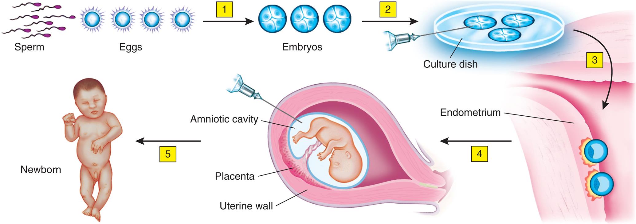 An illustrated flowchart shows the prepregnancy sickle cell test. The illustration shows sperm and eggs. Fertilization of sperm and eggs leads to embryos (1). The illustration shows embryonic cells in a culture dish (2). The embryos are implanted in the endometrium (3). The embryo develops into a fetus (4). A syringe collects sample from the amniotic cavity. Birth of a newborn (5). The placenta and the uterine wall are identified. The illustration shows a newborn.