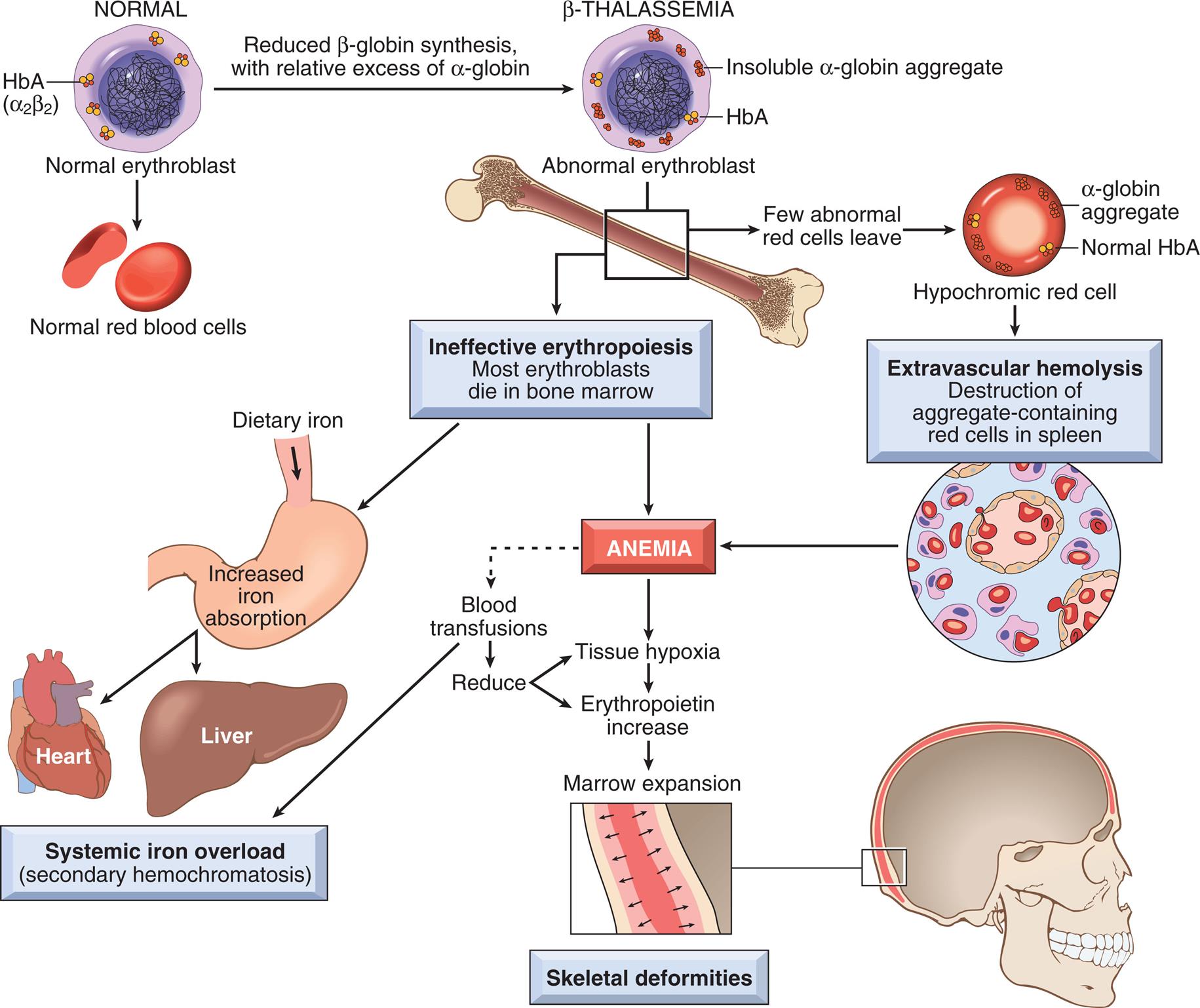 An illustrated flowchart shows the pathogenesis of beta-thalassemia major. • The illustration shows a normal cell with H b A (alpha sub 2 beta sub 2). • Normal erythroblast results in normal red blood cells. • Normal cell undergoes reduced beta-globin synthesis, with relative excess of alpha-globin, leading to beta-thalassemia. • The illustration of the abnormal erythroblast shows a cell with insoluble alpha-globin aggregate and H b A. • The illustration shows a bone. Few abnormal red cell leave the bone, forming a hypochromic red cell with alpha-globin aggregate and normal H b A. • Hypochromic red cell leads to extravascular hemolysis (destruction of aggregate-containing red cells in spleen), leading to anemia. • Ineffective erythropoiesis in bone marrow leads to most erythroblasts dying in bone marrow, resulting in anemia. • Ineffective erythropoiesis leads to increased iron absorption (from dietary iron), which leads to systemic iron overload (secondary hemochromatosis) in heart and liver. • Anemia leads to tissue hypoxia, which leads to erythropoietin increase, which leads to marrow expansion and skeletal deformities. • Blood transfusions reduce tissue hypoxia and erythropoietin. • Blood transfusions leads to systemic iron overload.