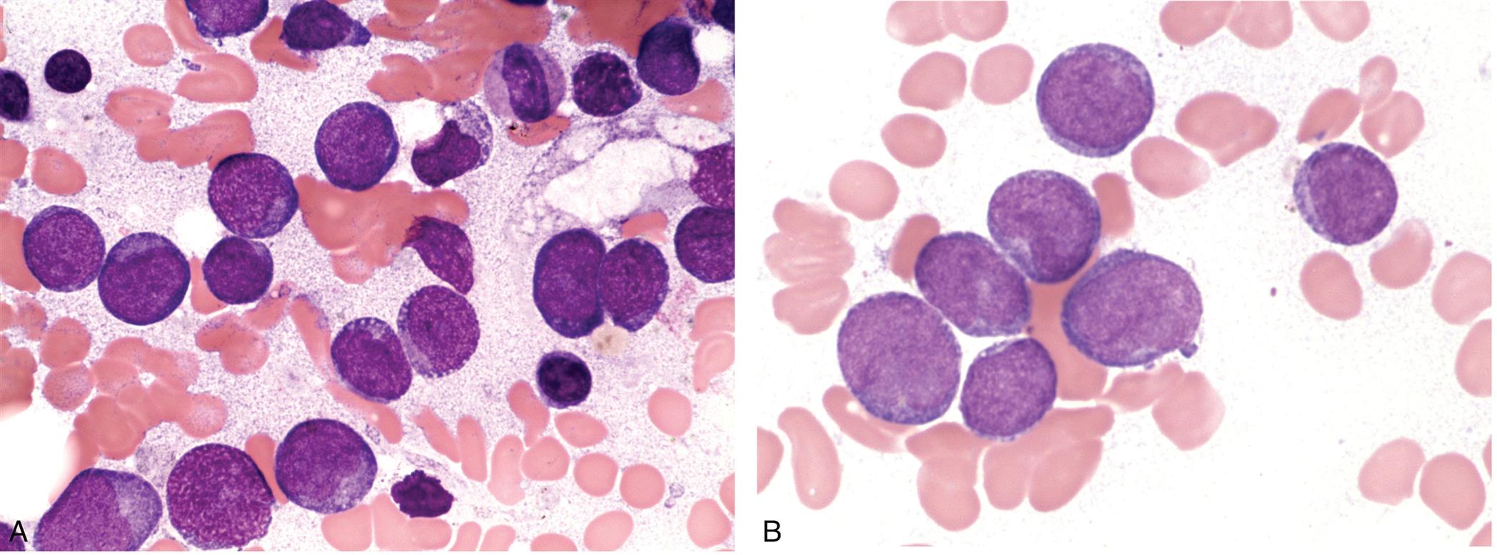 Two photomicrographs of bone marrow smears A and B show the morphology of acute myeloid leukemia. Photomicrograph A shows large blast cells with a low nucleus. Photomicrograph B shows numerous blasts cell with round nuclei.