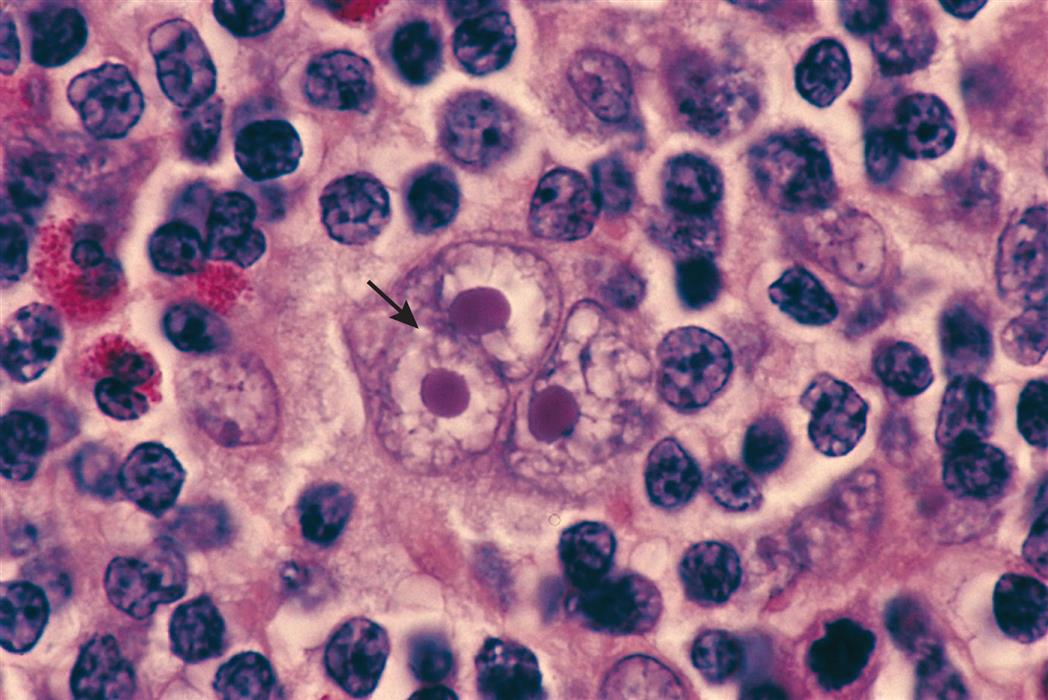A photomicrograph of the lymph node shows a large fused cluster with multiple nuclei and multiple cell bodies.