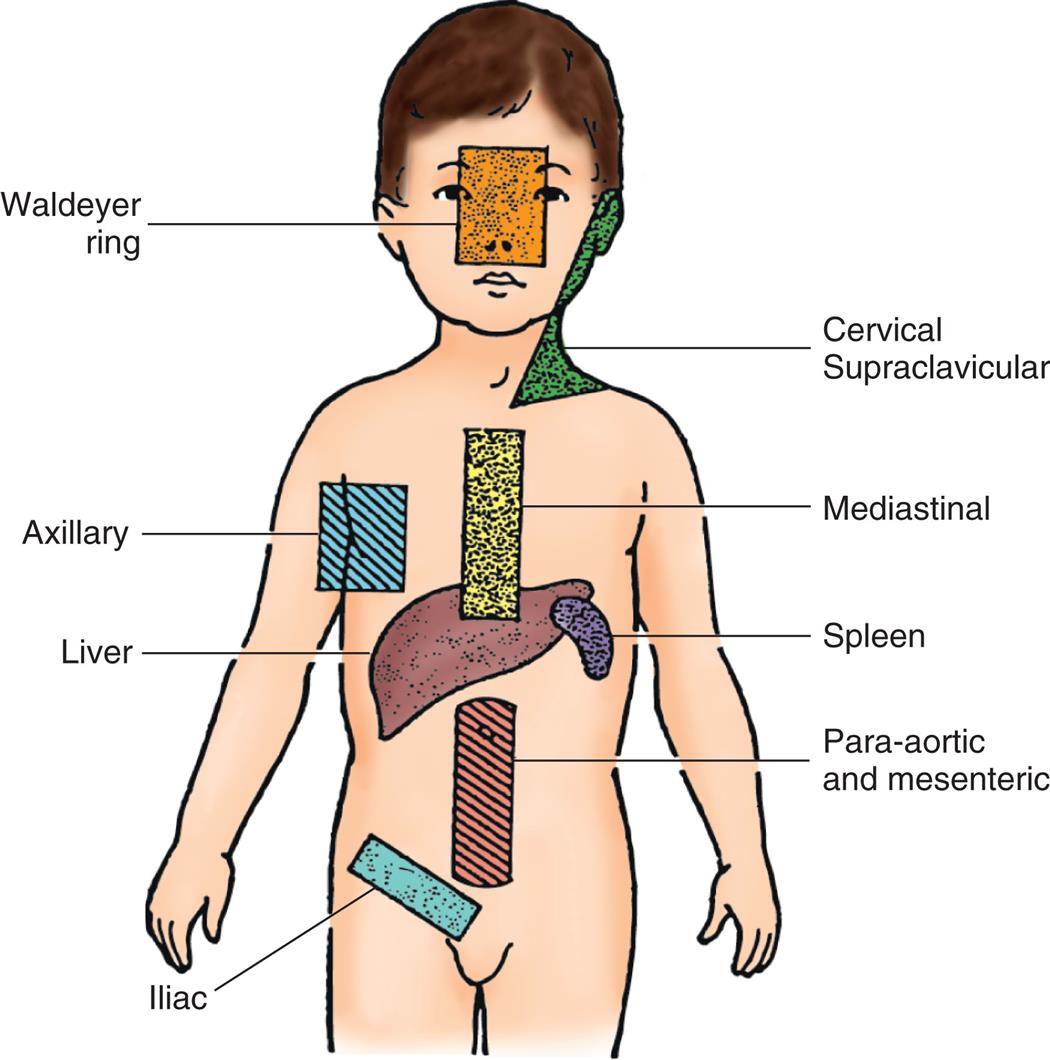 An illustration of the anterior view of the human body shows the main areas of lymphadenopathy and organ involvement in Hodgkin lymphoma: Waldeyer ring, cervical supraclavicular, mediastinal, axillary, liver, spleen, para-aortic and mesenteric, and iliac.