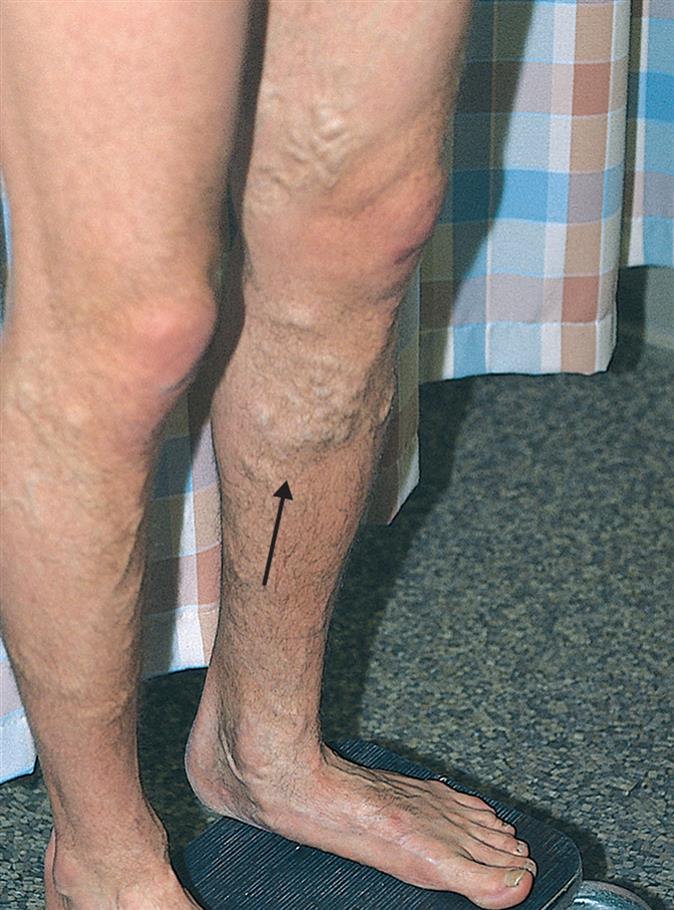 A closeup of legs shows legs with veins swollen, majorly below the left knee (indicated by an arrow).