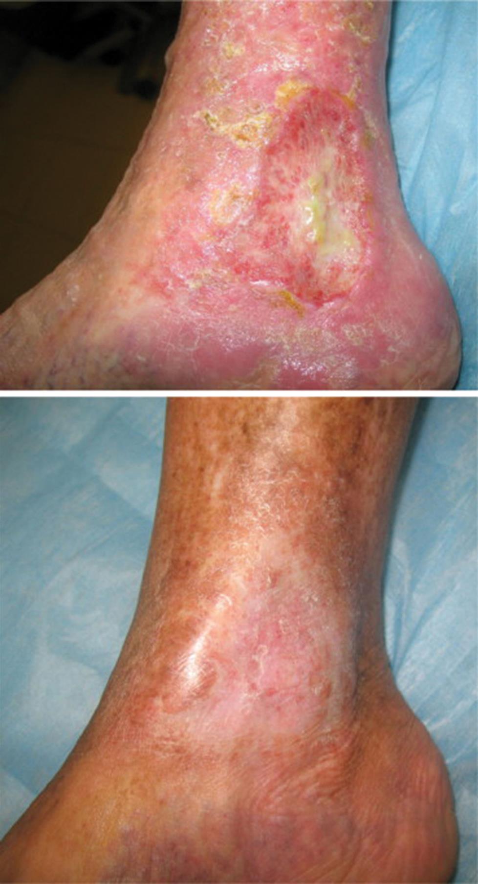 Top panel: A closeup of the ankle with an ovular wound with yellowish tissue at the center. Bottom panel: A closeup of the ankle at the bottom with healed tissue in place of the wound.