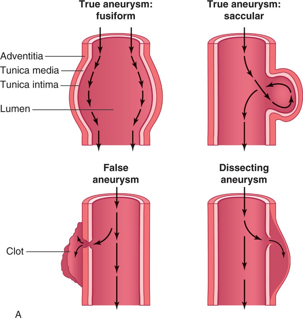 Left panel, A. True aneurysm: fusiform. Illustration shows labels for adventitia, tunica media, tunica intima, and lumen. Arrows along the inner walls represent the flow. True aneurysm: saccular. Illustration shows bulging of outer three layers on one side. Arrows, representing the flow, are traced along the wall, looping through the bulge, and flowing further down. False aneurysm. Illustration shows formation of clot. Arrows along the center of the longitudinal section represent direction of flow. Part of the flow also enters the clot. Dissecting aneurysm. Illustration shows broken tunica media and tunica intima on one side. Arrows along the center of the longitudinal section represent direction of flow. Part of the flow also enters the broken section. Right panel, B. Specimen of thoracic aorta shows enlarged artery with extra growth of tissue.