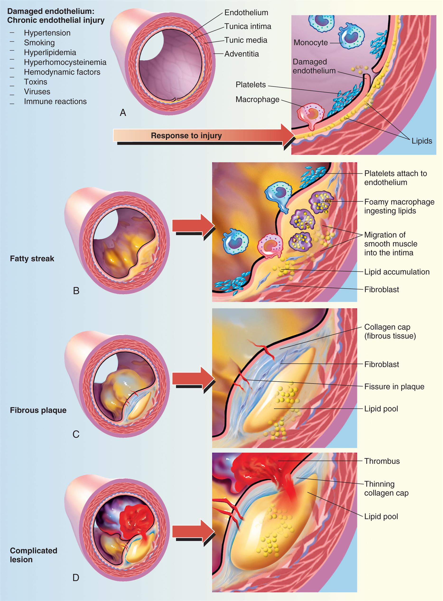 Panel a. Illustration of vessel shows labels as follows: endothelium, tunica intima, tunic media, and adventitia. The symptoms of damaged endothelium: chronic endothelial injury are hypertension, smoking, hyperlipidemia, hyperhomocysteinemia, hemodynamic factors, toxins, viruses, and immune reactions. An arrow labeled response to injury points toward a cross-section that shows labels as follows: monocyte, damaged endothelium, platelets, macrophage, and lipids. Panel b. Illustration labeled fatty streak shows buildup of plaque inside endothelium. Cross-section of fatty streak shows labels as follows: platelets attach to endothelium, foamy macrophage ingesting lipids, migration of smooth muscle into the intima, lipid accumulation, and fibroblast. Panel c. Illustration labeled fibrous plaque shows blue and yellow deposits. Cross-section of fibrous plaque shows labels as follows: collagen cap (fibrous tissue), fibroblast, fissure in plaque, and lipid pool. Panel d. Illustration labeled complicated lesion shows build-up of plaque and blood clot. Cross-section of complicated lesion shows labels as follows: thrombus, thinning collagen cap, and lipid pool.