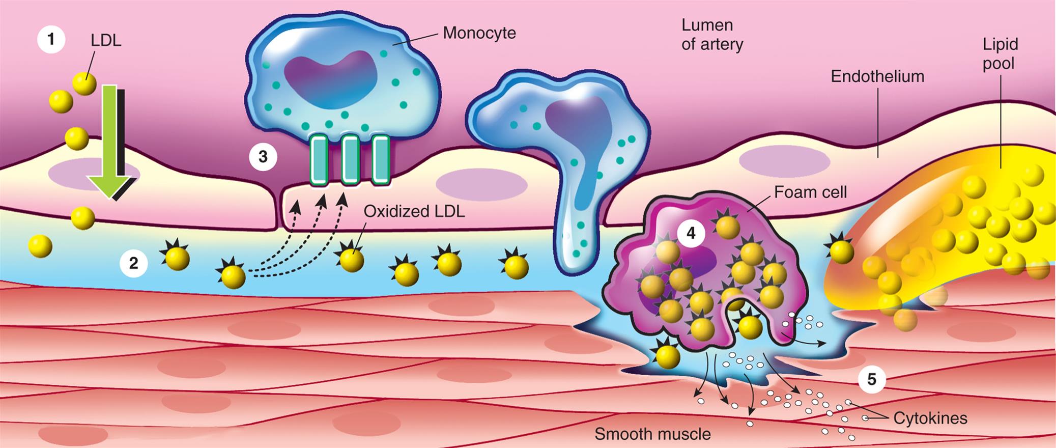 An illustration shows the process of ow-density lipoprotein oxidation.