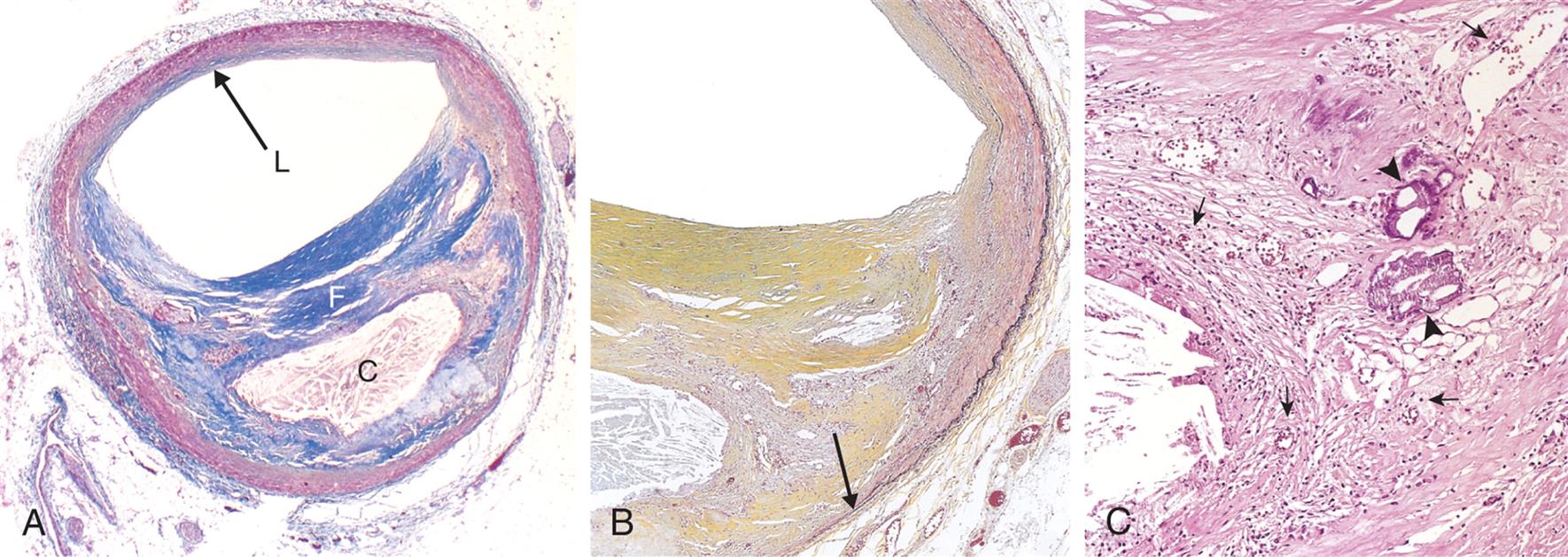 Three photomicrographs, A, B, and C, show histologic features of plaque.