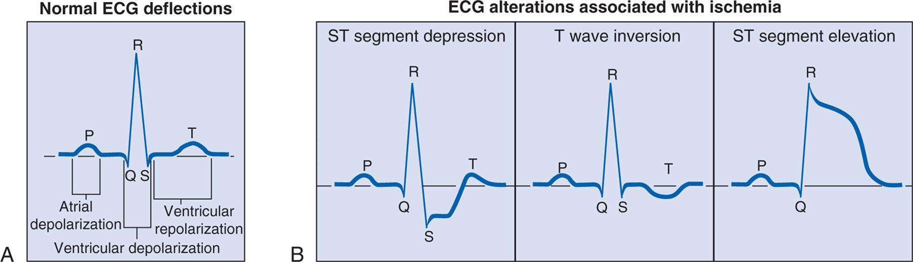 Left panel, A. Electrocardiogram labeled normal E C G deflections shows gentle peak labeled P and atrial depolarization, followed by a sharp and tall peak, marked R. The area under Q R S is labeled ventricular depolarization. It is followed by another gentle peak labeled T. Area from S to T is labeled ventricular repolarization. Right panel, B. Electrocardiogram labeled E C G alterations associated with ischemia is as follows: S T segment depression: It shows sharp and tall peak labeled R and depression at S. T wave inversion shows trough labeled T. S T segment elevation shows curve reaches at height labeled R, followed by fluctuations while sloping down.