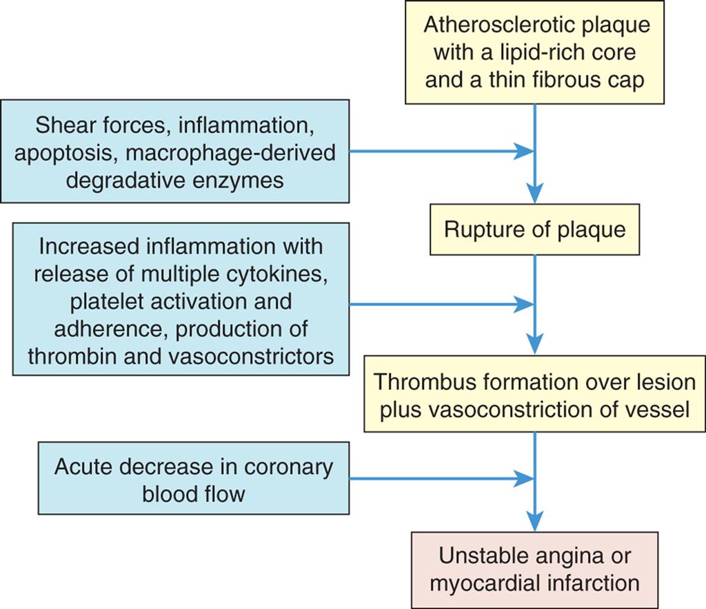 A flowchart represents the pathogenesis of unstable plaques and thrombus formation. 1. Atherosclerotic plaque with a lipid-rich core and a thin fibrous cap. Leads to 3. 2. Shear forces, inflammation, apoptosis, macrophage-derived degradative enzymes. Leads to 3. 3. Rupture of plaque. Leads to 5. 4. Increased inflammation with release of multiple cytokines, platelet activation and adherence, production of thrombin and vasoconstrictors. Leads to 5. 5. Thrombus formation over lesion plus vasoconstriction of vessel. Leads to 7. 6. Acute decrease in coronary blood. Leads to 7. 7. Unstable angina or myocardial infarction.