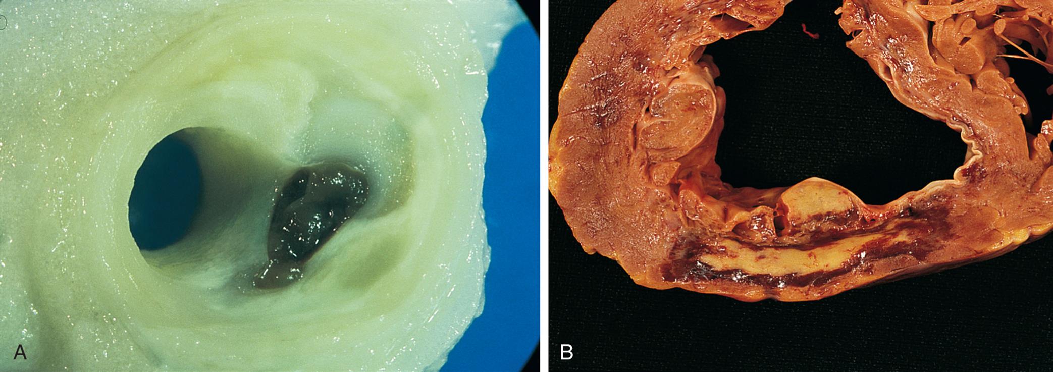 Two photomicrographs, A and B, show plaque disruption and myocardial infraction.