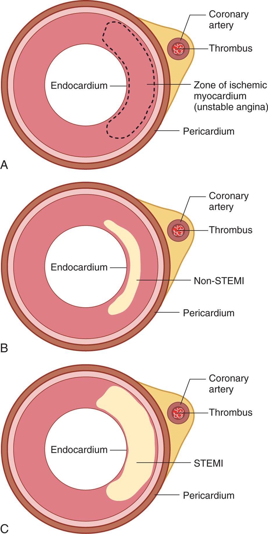 Three illustrations A through B depict the cross section of coronary artery of different types of myocardial infarction. Top panel, Part A. The illustration depicts unstable angina showing the coronary thrombosis leading to myocardial infarction with parts labeled as follows. coronary artery, thrombus, zone of ischemic myocardium (unstable angina), and pericardium. Middle panel, Part B. The illustration depicts Non-S T E M I showing the coronary thrombosis leading infarction of the myocardium closest to the endocardium with labels as follows. Coronary artery, thrombus, Non-STEMI, and pericardium. Bottom panel, Part C. The illustration depicts S T E M I showing the coronary thrombosis leading infarction of the myocardium extending to pericardium with labels as follows. Coronary artery, thrombus, S T E M I, and pericardium.