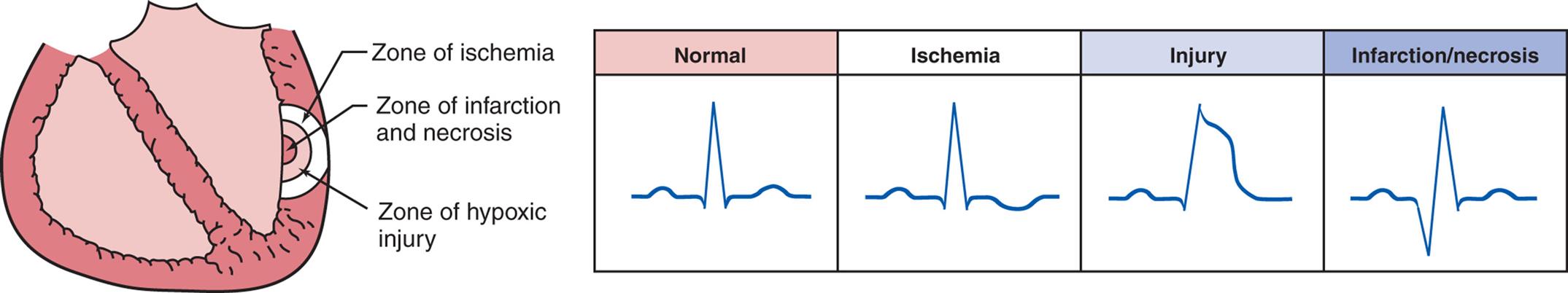 An illustration of cross-section of the heart indicating the following zones from the inside to the outside: a zone of ischemia, zone of infarction, and zone of hypoxic injury. An accompanying table comprises the electrocardiogram of normal, ischemic, injury, and infarction or necrosis.