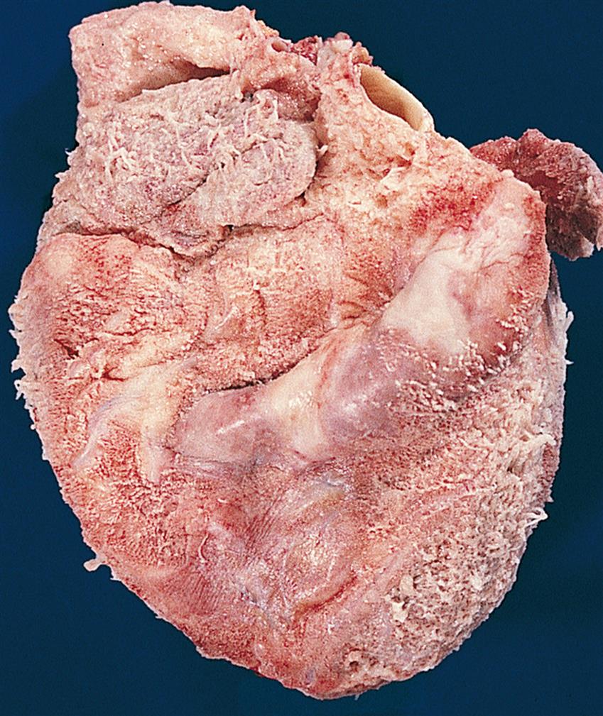 A closeup of a human heart with an uneven outer surface with white fibrous outer surface.