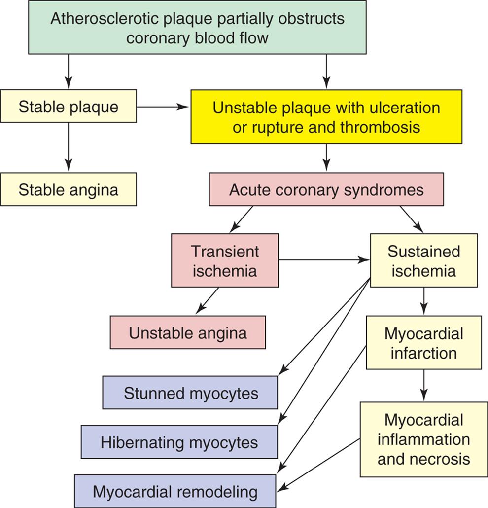 A flowchart shows the pathophysiology of acute coronary syndromes. 1. Atherosclerotic plaque partially obstructs coronary blood flow. Leads to 2 and 12. 2. Unstable plaque with ulceration or rupture and thrombosis. Leads to 3. 3. Acute coronary syndromes. Leads to 4 and 5. 4. Transient ischemia. Leads to 5 and 6. 5. Sustained ischemia. Leads to 7, 8, and 10. 6. Unstable angina. 7. Stunned myocytes. 8. Hibernating myocytes. 9. Myocardial remodeling. 10. Myocardial infarction. Leads to 9 and 11. 11. Myocardial inflammation and necrosis. 12. Stable plaque. Leads to 2 and 13. 13. Stable angina.
