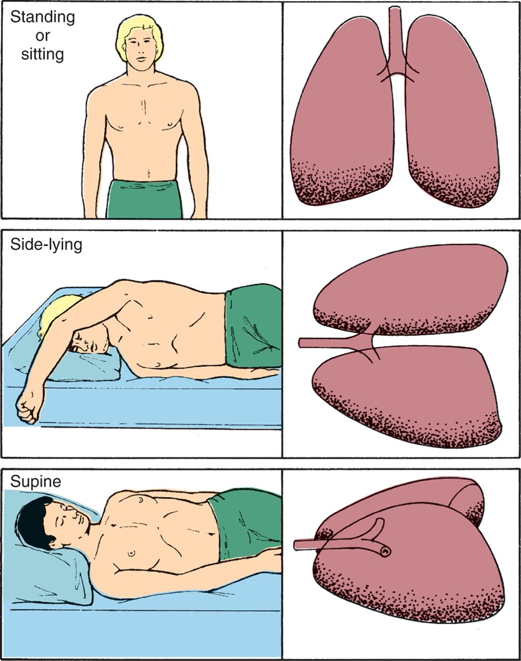 Three pairs of illustrations show the upper body and lungs of a person, respectively. Top panel. The illustration on the left shows the anterior view of a person standing (or sitting). The illustration on the right shows the anterior view of the lungs. Middle panel. The illustration on the left shows a person lying on their side (side-lying). The illustration on the right shows the anterior view of the lungs on the side. Bottom panel. The illustration on the left shows a person in supine position. The illustration on the right shows a lateral view of the lungs on the side.