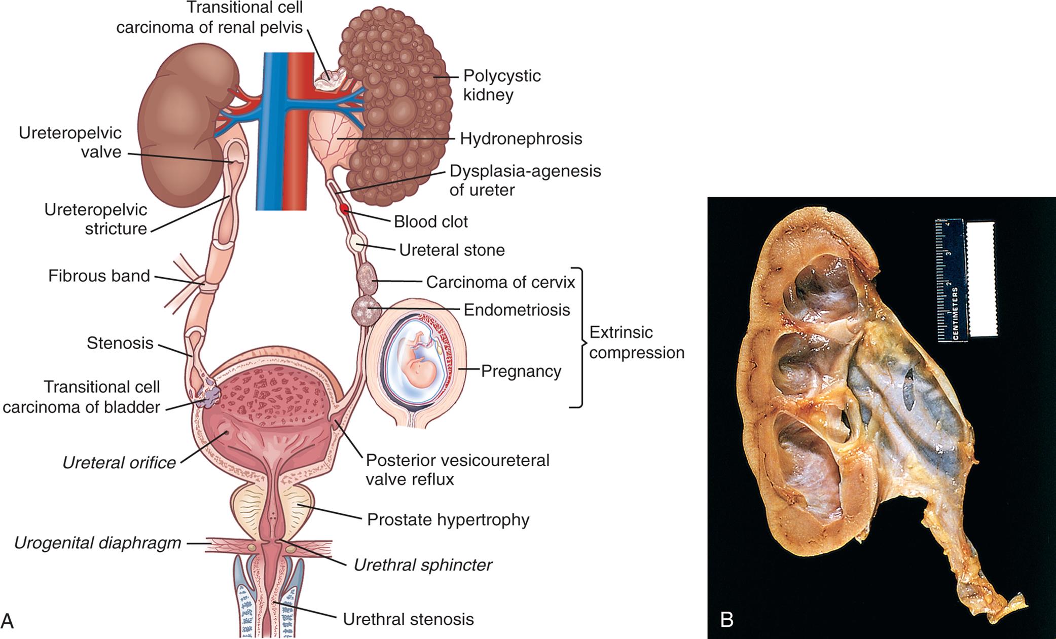 Left panel, A. The illustration shows the urinary system. The followings structures are labeled, clockwise from the top: transitional cell carcinoma of renal pelvis, polycystic kidney, hydronephrosis, dysplasia-agenesis of ureter, blood clot, ureteral stone, extrinsic compression (carcinoma of cervix, endometriosis, and pregnancy), posterior vesicoureteral valve reflux, prostate hypertrophy, urethral sphincter, urethral stenosis, urogenital diaphragm, ureteral orifice, transitional cell carcinoma of bladder, stenosis, fibrous band, ureteropelvic stricture, and ureteropelvic valve.