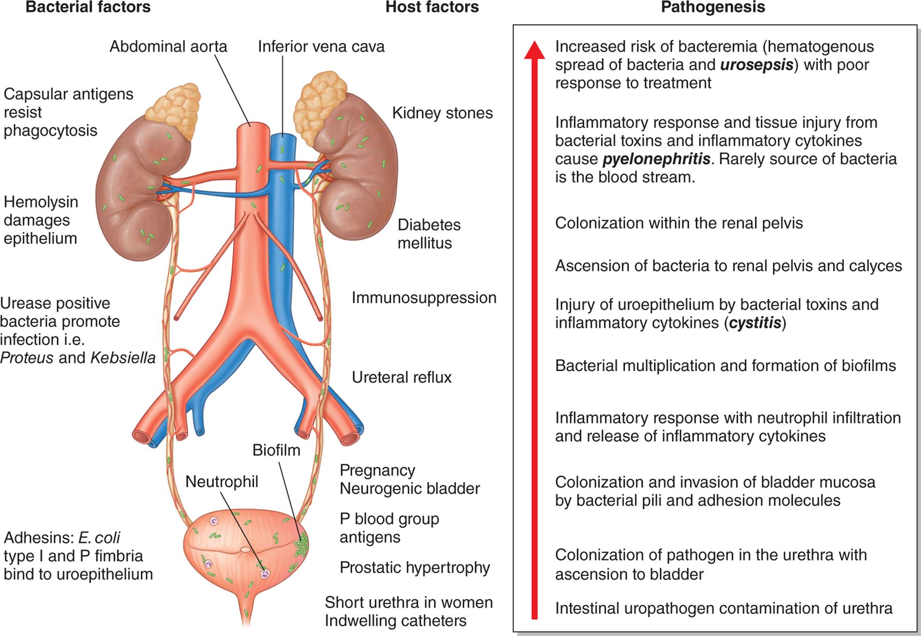 An illustration shows the mechanisms of urinary tract infection. The illustration shows and labels the following structures on the urinary system: abdominal aorta, inferior vena cava, biofilm, and neutrophil. The bacterial factors include capsular antigens resist phagocytosis; hemolysin damages epithelium; urease positive bacteria promote infection, that is proteus and kebsiella; and adhesins: E coli type 1 and P fimbria bind to uroepithelium. The host factors include kidney stones; diabetes mellitus; immunosuppression; ureteral reflux; pregnancy neurogenic bladder; P blood group antigens; prostatic hypertrophy; and short urethra in women indwelling catheters. The pathogenesis, from the bottom to the top, is as follows. • Intestinal uropathogen contamination of urethra. • Colonization of urethra with ascension to bladder. • Colonization and invasion of bladder mucosa by bacterial pili and adhesion molecules. • Inflammatory response with neutrophil infiltration and release of inflammatory cytokines. • Bacterial multiplication and formation of biofilms. • Injury of uroepithelium by bacterial toxins and inflammatory cytokines (cystitis). • Ascension of bacteria to renal pelvis and calyces. • Colonization of renal pelvis. • Inflammatory response and tissue injury from bacterial toxins and inflammatory cytokines cause pyelonephritis. Rarely source of bacteria is the blood stream. • Increased risk of bacteremia (hematogenous spread of bacteria and urosepsis) with poor response to treatment.