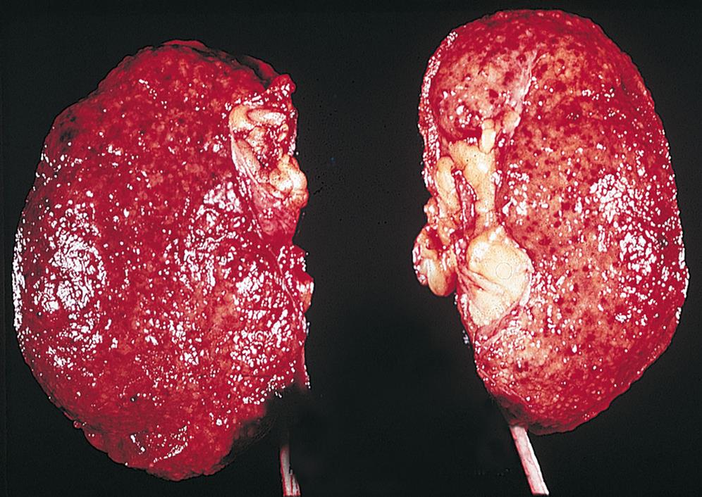 A closeup of kidneys with chronic glomerulonephritis shows scars and atrophies.