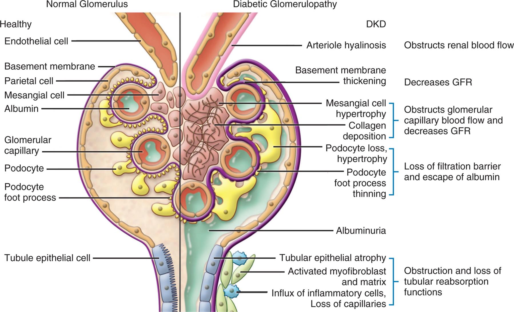 An illustration of the cross-section of the glomerulus compares the structures of normal glomerulus and diabetic glomerulopathy. Normal glomerulus: healthy endothelial cell, basement membrane, parietal cell, mesangial cell, albumin, glomerular capillary, podocyte foot process, and tubule epithelial cell. Diabetic glomerulopathy: D K D, obstructs renal blood flow (arteriole hyalinosis), decreases G F R (basement membrane thickening), obstructs glomerular capillary blood flow and decreases G F R (mesangial cell hypertrophy, collagen deposition), loss of filtration barrier and escape of albumin (podocyte loss, hypertrophy, podocyte foot process thinning), albuminuria, and obstruction and loss of tubular reabsorption functions (tubular epithelial atrophy, activated myofibroblast and matrix, and influx of inflammatory cells, loss of capillaries).