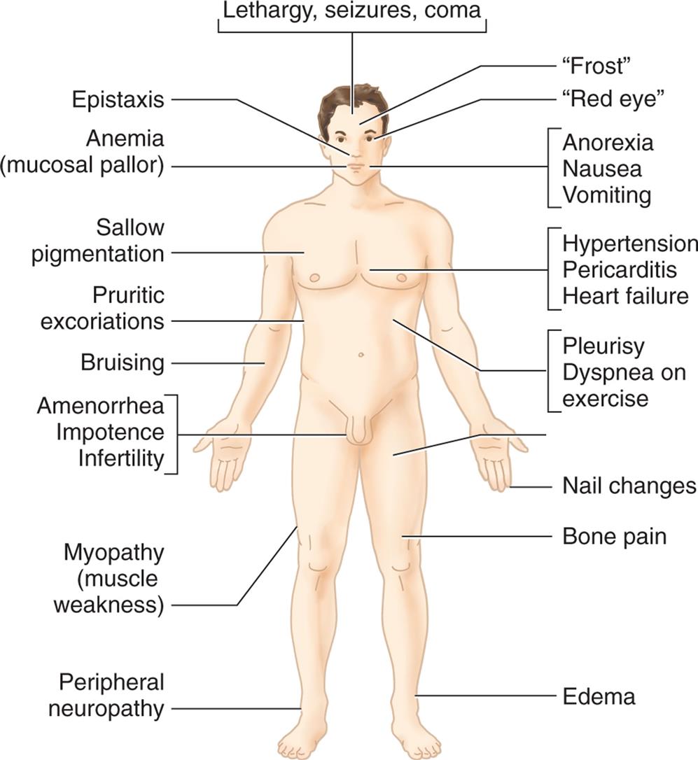 An illustration of the anterior view of the human body identifies the common signs and symptoms of kidney dysfunction, clockwise from the top: lethargy, seizures, coma; frost; red eye; anorexia, nausea, vomiting; hypertension, pericarditis, heart failure; pleurisy, dyspnea on exercise; nail changes; bone pain; edema; peripheral neuropathy; myopathy (muscle weakness); amenorrhea, impotence, infertility; bruising; pruritic excoriations; sallow pigmentation; anemia (mucosal pallor); and epistaxis.