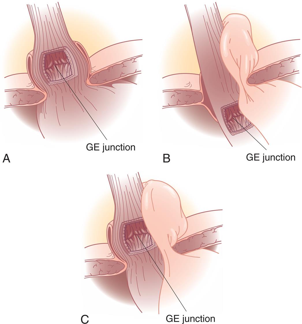 Three illustrations depict the three types of hiatal hernia. Illustration A depicts the sliding hernia, which shows the G E junction above the level of diaphragmatic hiatus. Illustration B depicts the rolling hernias, which shows a normal position to the G E junction, but a portion of the fundus above the hiatus. Illustration C depicts the mixed hernia, which shows displacement of both the G E junction and fundus above the hiatus.