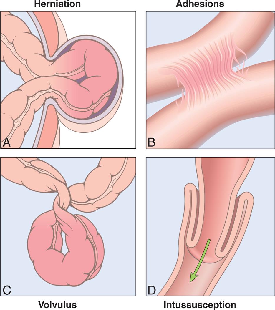 Four illustrations, A through D, depicts the intestinal obstruction. Illustration A depicts the herniation, which shows the small intestine pushing through the abdominal wall. Illustration B depicts the adhesion, which shows fibrous bands formed between the tissues and organs. Illustration C depicts the volvulus, which shows the twisting of the bowel upon itself. Illustration D depicts the intussusception, which shows the small intestine in the large intestine.